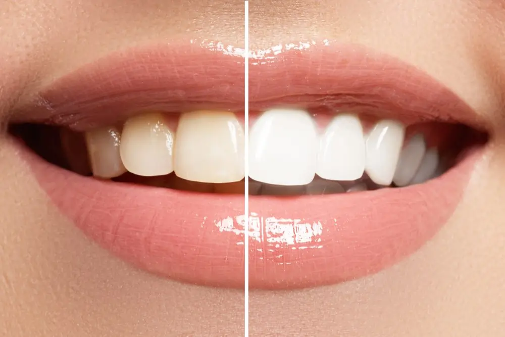 A smiling person showing off their freshly whitened teeth after a lazer treatment Hemel-Hempstead