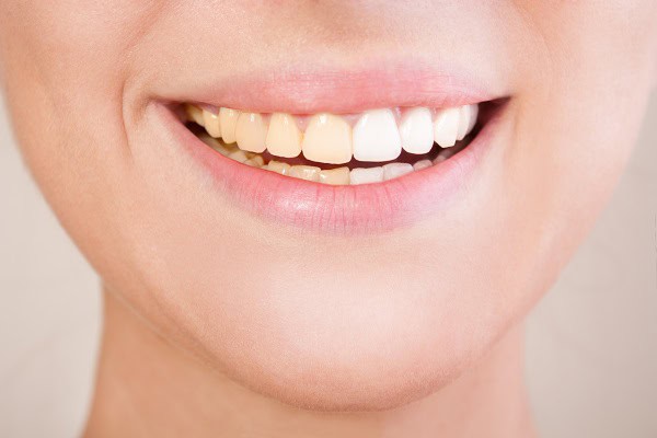 Side-by-side comparison of teeth before and after a lazer whitening session. Hemel-Hempstead