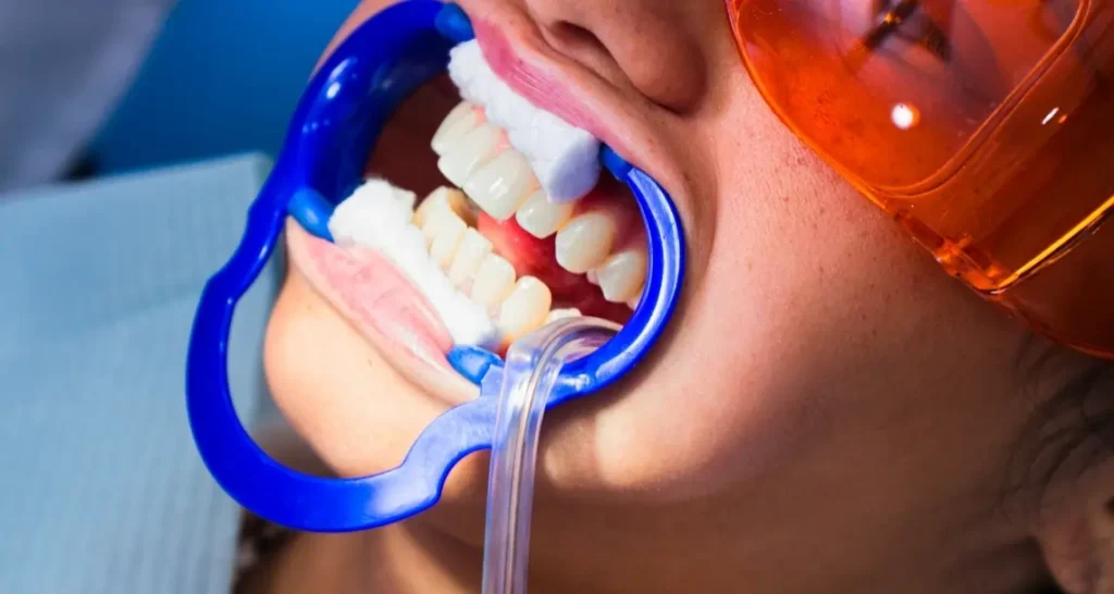 Illustration of teeth with surface-level yellow and brown stains caused by coffee and tobacco Hemel-Hempstead