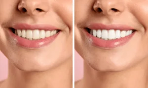 Smiling person undergoing Laser Teeth Whitening for a brighter smile Hemel-Hempstead