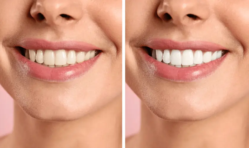 Smiling person undergoing Laser Teeth Whitening for a brighter smile Hemel-Hempstead