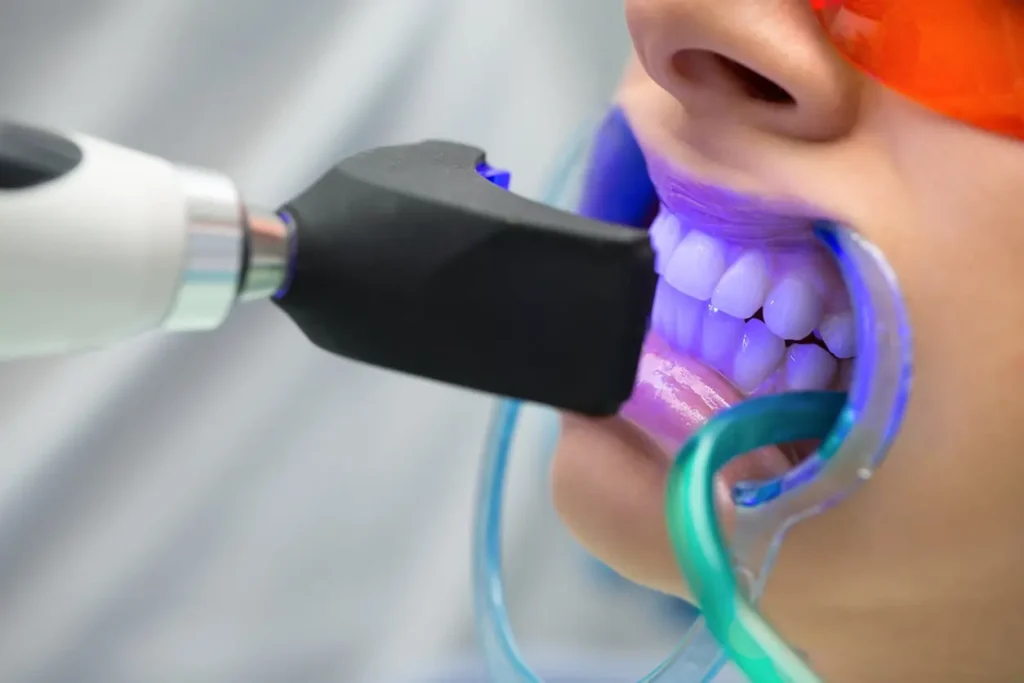 Will I See Immediate Results from Lazer Teeth Whitening Hemel-Hempstead